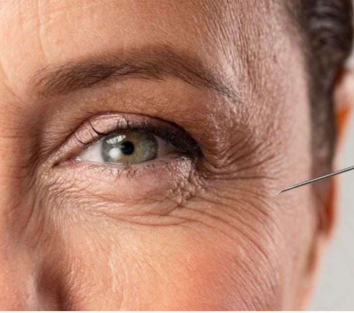 Aesthetic practitioner demonstrating jelly roll toxin injection technique on model — CPD accredited online training course