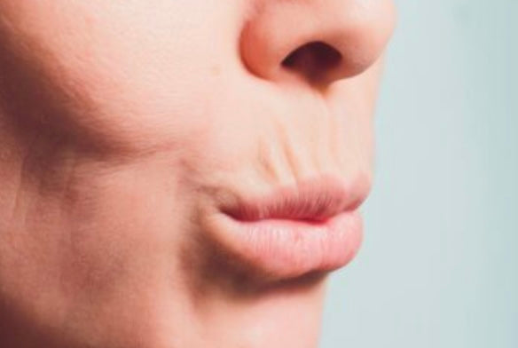 Dynamic Horizontal Rhytids Perioral Rhytids (Smoker’s Lines) | Online Training Course | CPD ...